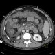Liver cirrhosis, ascites, portal colonopathy, colopathy: CT - Computed tomography